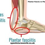 Plantar Fascia vs Plantar Fasciitis