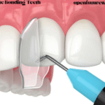 Composite Bonding Teeth
