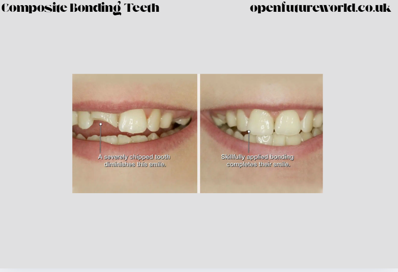 Composite Bonding Teeth