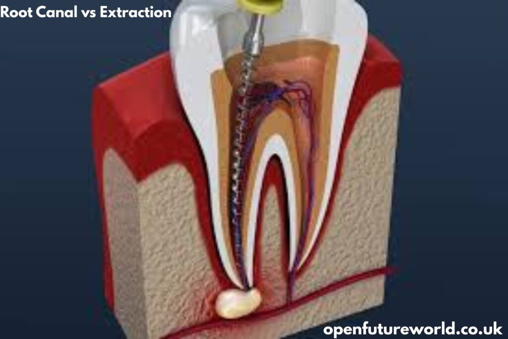 Root Canal vs Extraction